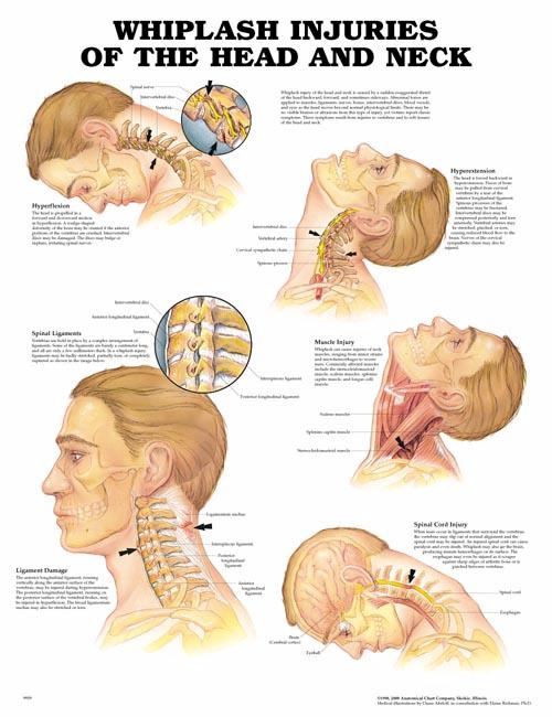 whiplash-injuries.jpg